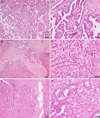 Multiple Simultaneous Rare Distant Metastases as the Initial Presentation of Papillary Thyroid Carcinoma: A Case Report